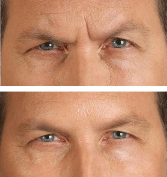Before and After Botox photo