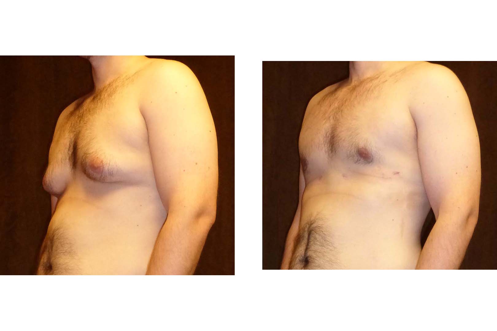 удаление жира на груди мужчин фото 34