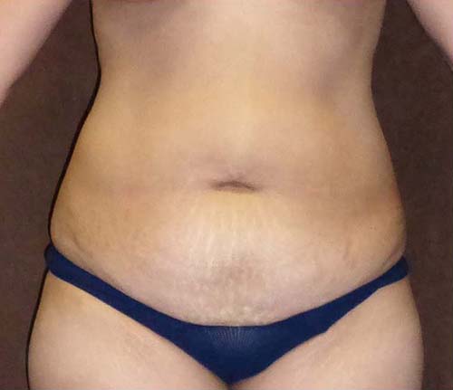 Tummy Tuck (Abdominoplasty)