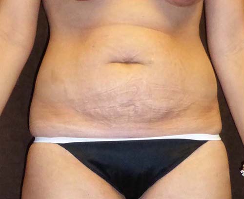 Tummy Tuck (Abdominoplasty)