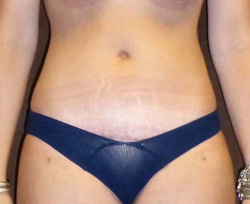 Tummy Tuck (Abdominoplasty)