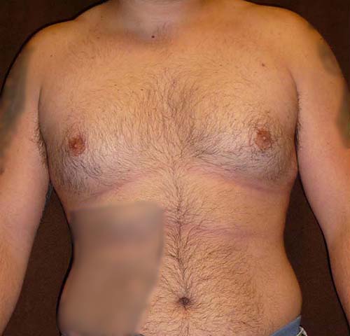Male Breast Reduction