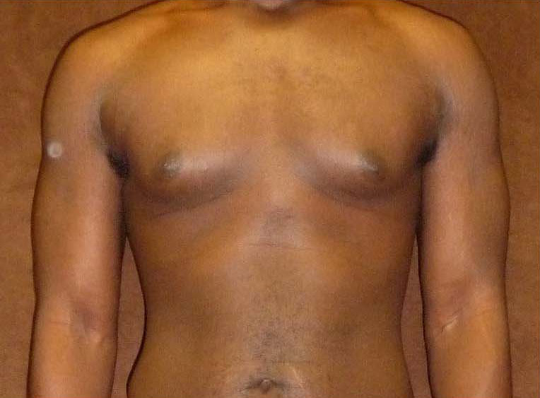 Male Breast Reduction