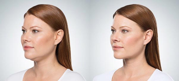 Before and After Kybella in Dallas