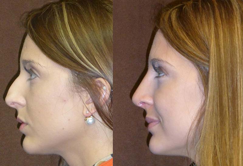 Before and After Nose Surgery