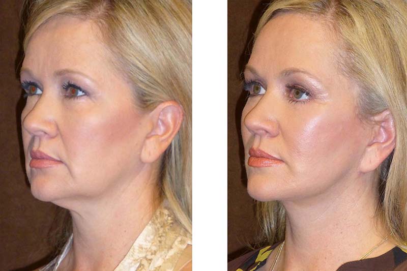 Facelift Fort Worth Neck Lift Dallas Facial Rejuvenation