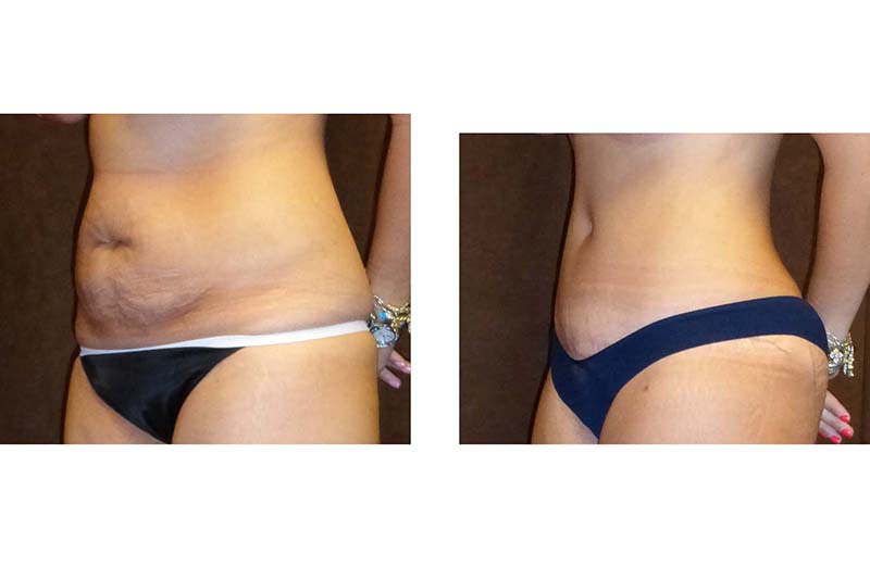 Tummy Tuck