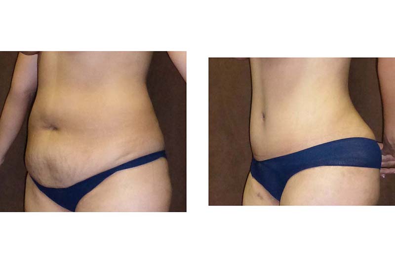 tummy tuck high waisted bikini