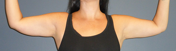 woman's arms after bodytite, front view