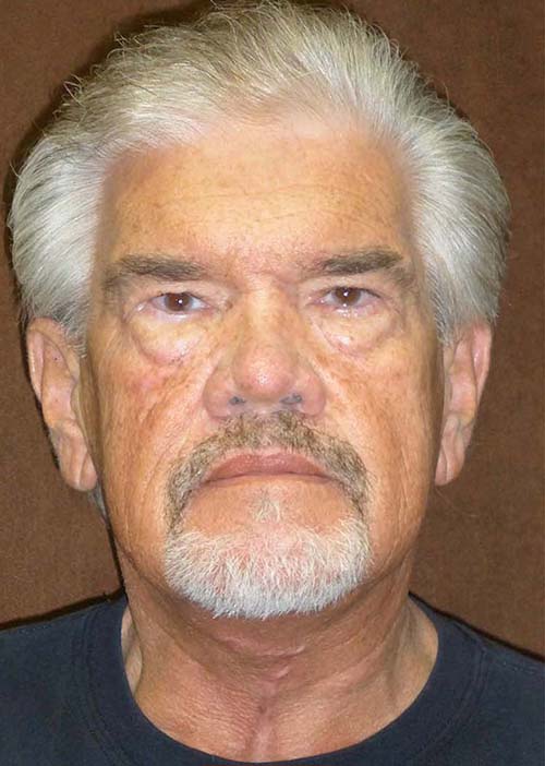 man's neck after neck lift, front view