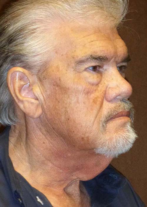 man's neck before neck lift, right angle
