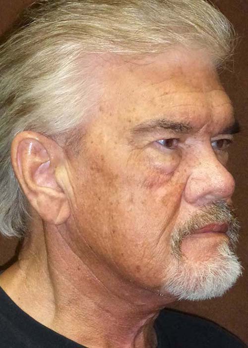 man's neck after neck lift, right angle