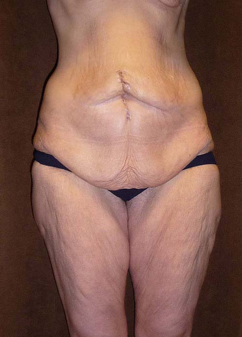 woman's body before lower body lift, front view