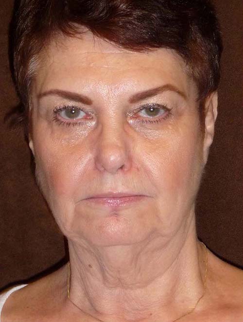 woman's face and neck before MACS facelift, front view