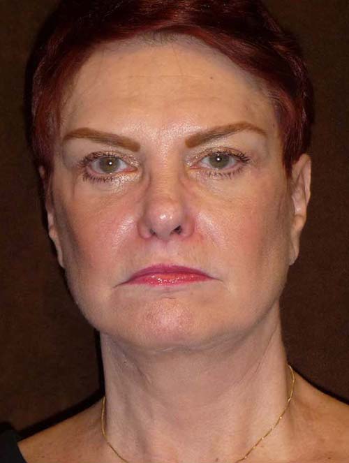 woman's face and neck after MACS facelift, front view