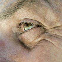 Male Brow & Eyelid surgery