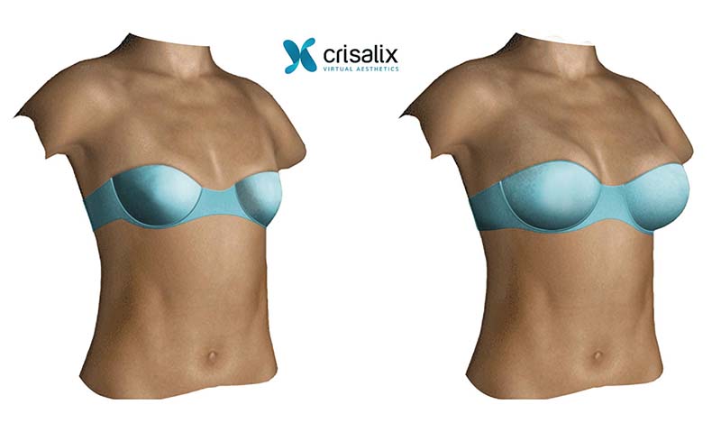 Breast Lift Mastopexy, Dallas Fort Worth