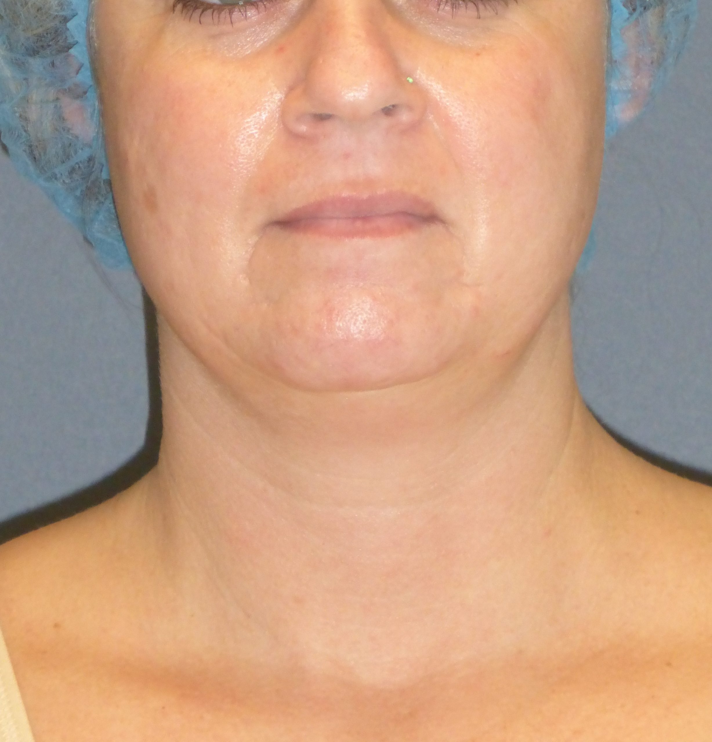 woman's double chin before facetite, front view case 1941
