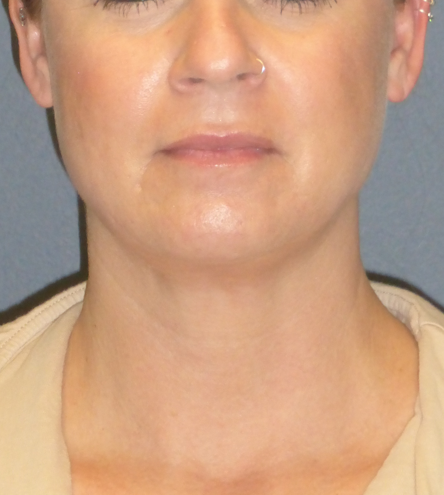 woman's double chin after facetite, front view case 1941