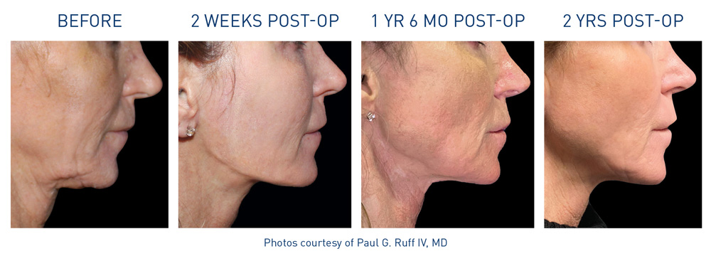 Neck before and afters 1 Flyer Ruff 72dpi