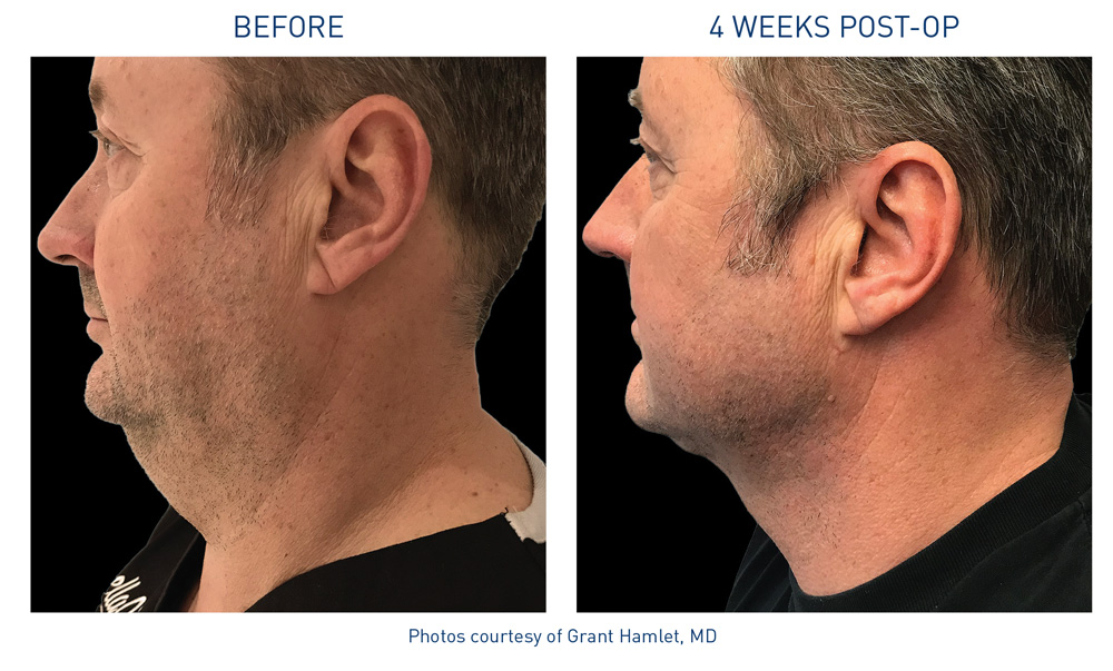 Neck before and afters 4 Flyer Hamlet 72dpi