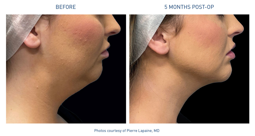 Neck before and afters Neck Flyer 72dpi