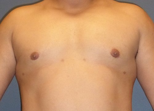 BR3before-5