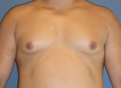BR3before-5